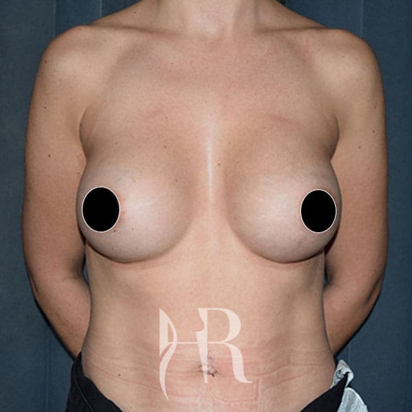 HR Plastic Surgery - Breast Enlargement patient after 1